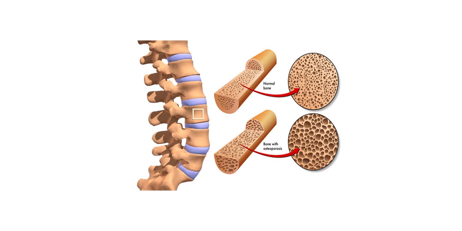 Bone Density